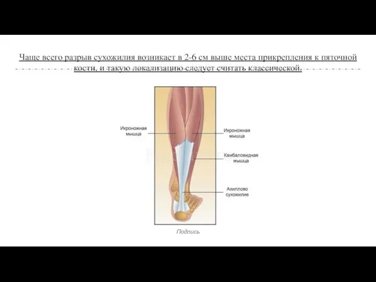 Чаще всего разрыв сухожилия возникает в 2-6 см выше места прикрепления