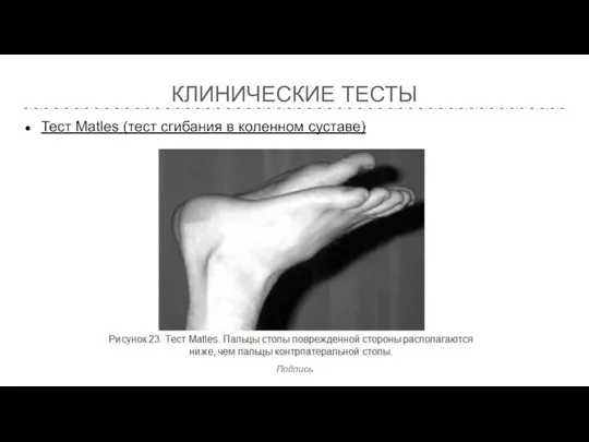 КЛИНИЧЕСКИЕ ТЕСТЫ Тест Matles (тест сгибания в коленном суставе)