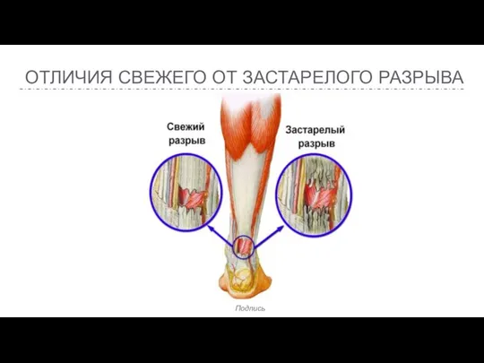 ОТЛИЧИЯ СВЕЖЕГО ОТ ЗАСТАРЕЛОГО РАЗРЫВА