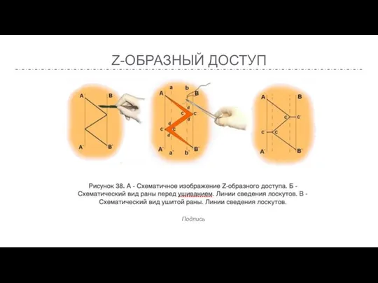 Z-ОБРАЗНЫЙ ДОСТУП