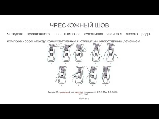 ЧРЕСКОЖНЫЙ ШОВ Методика чрескожного шва ахиллова сухожилия является своего рода компромиссом