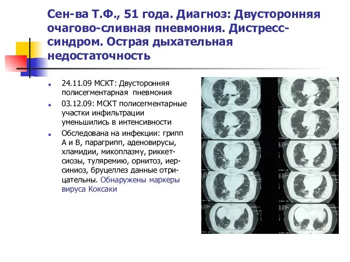 Сен-ва Т.Ф., 51 года. Диагноз: Двусторонняя очагово-сливная пневмония. Дистресс-синдром. Острая дыхательная