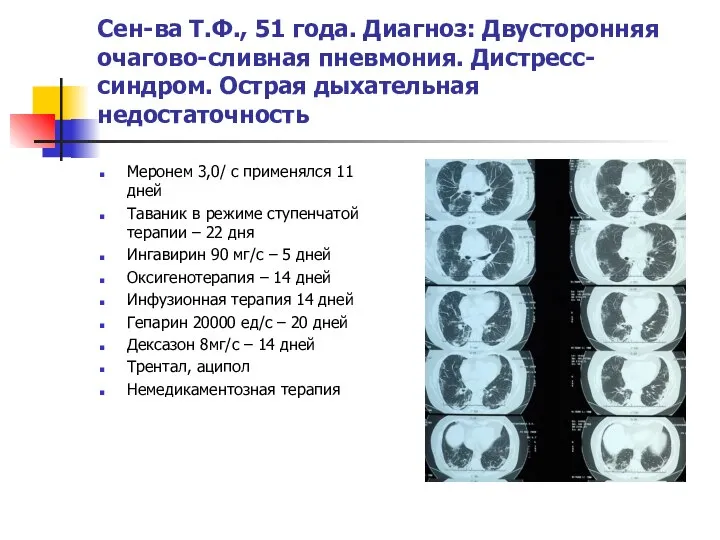 Сен-ва Т.Ф., 51 года. Диагноз: Двусторонняя очагово-сливная пневмония. Дистресс-синдром. Острая дыхательная