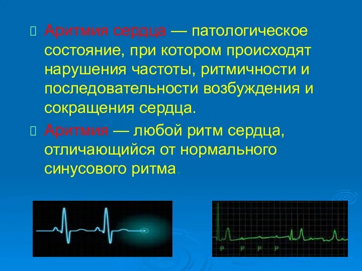 Аритмия сердца — патологическое состояние, при котором происходят нарушения частоты, ритмичности