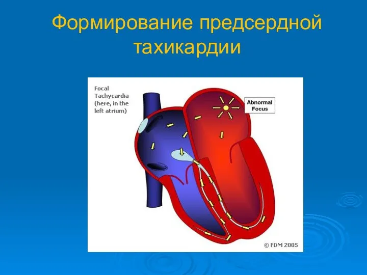 Формирование предсердной тахикардии