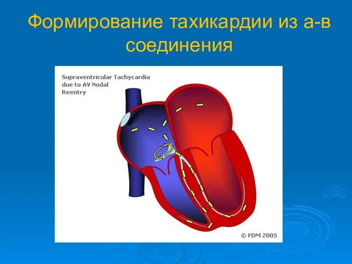 Формирование тахикардии из а-в соединения