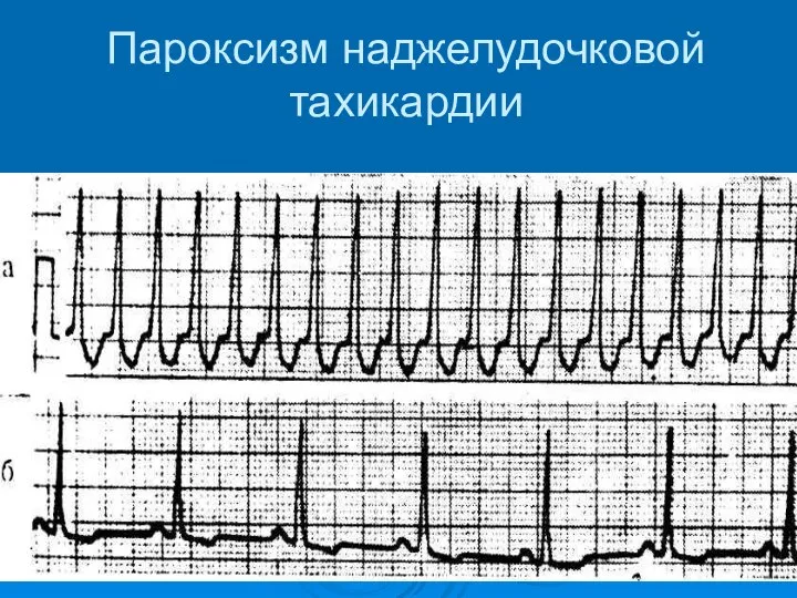 Пароксизм наджелудочковой тахикардии