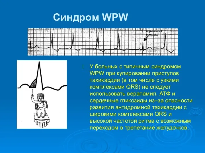 Синдром WPW У больных с типичным синдромом WPW при купировании приступов