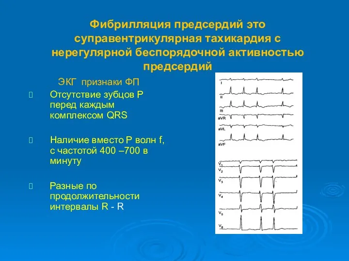 Фибрилляция предсердий это суправентрикулярная тахикардия с нерегулярной беспорядочной активностью предсердий ЭКГ