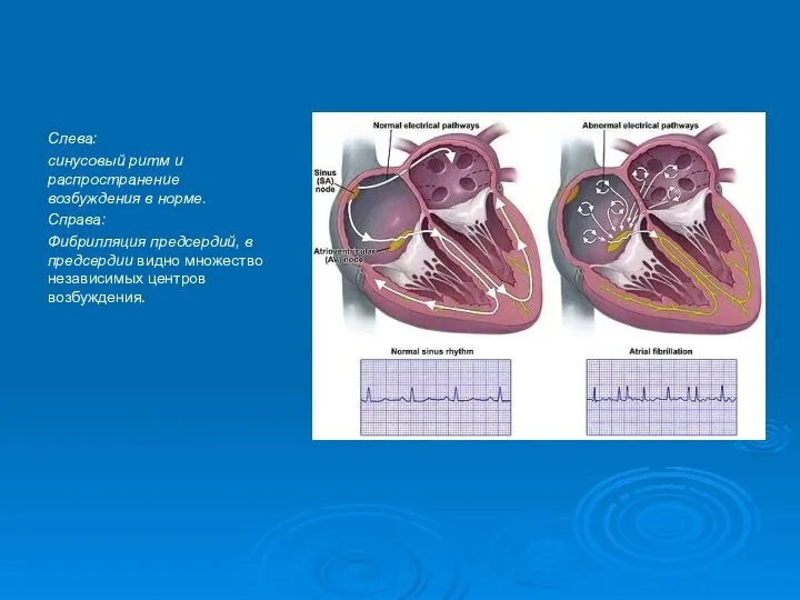 Слева: синусовый ритм и распространение возбуждения в норме. Справа: Фибрилляция предсердий,