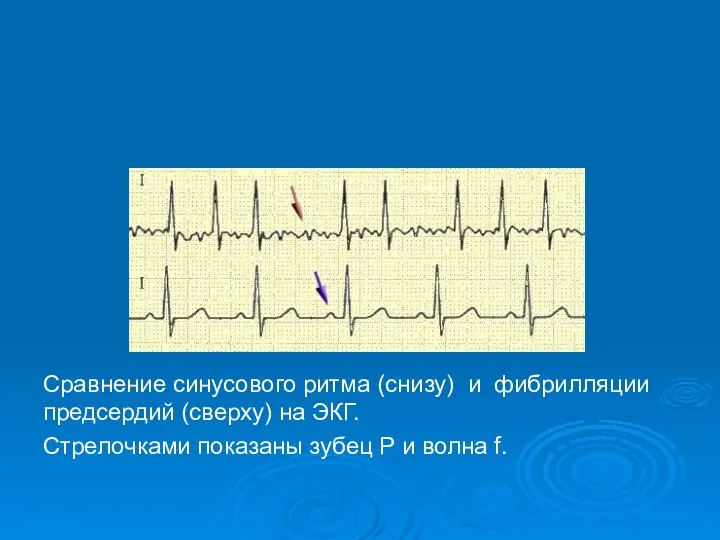 Сравнение синусового ритма (снизу) и фибрилляции предсердий (сверху) на ЭКГ. Стрелочками