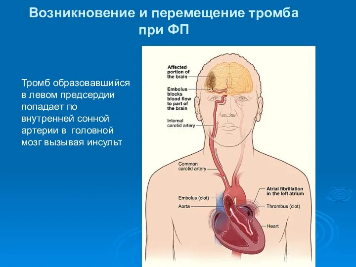 Возникновение и перемещение тромба при ФП Тромб образовавшийся в левом предсердии