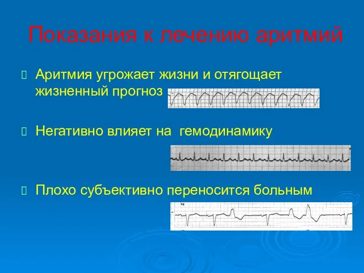 Показания к лечению аритмий Аритмия угрожает жизни и отягощает жизненный прогноз