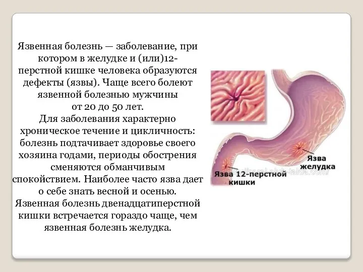 Язвенная болезнь — заболевание, при котором в желудке и (или)12-перстной кишке