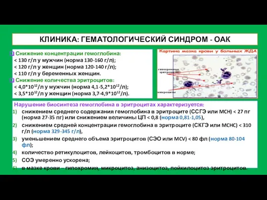 КЛИНИКА: ГЕМАТОЛОГИЧЕСКИЙ СИНДРОМ - ОАК Снижение концентрации гемоглобина: Снижение количества эритроцитов: