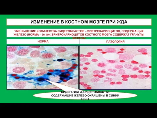 ИЗМЕНЕНИЕ В КОСТНОМ МОЗГЕ ПРИ ЖДА УМЕНЬШЕНИЕ КОЛИЧЕСТВА СИДЕРОБЛАСТОВ – ЭРИТРОКАРИОЦИТОВ,