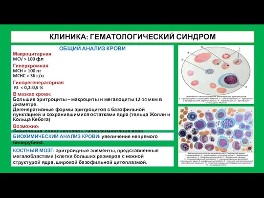 КЛИНИКА: ГЕМАТОЛОГИЧЕСКИЙ СИНДРОМ КОСТНЫЙ МОЗГ: эритроидные элементы, представленные мегалобластами (клетки больших