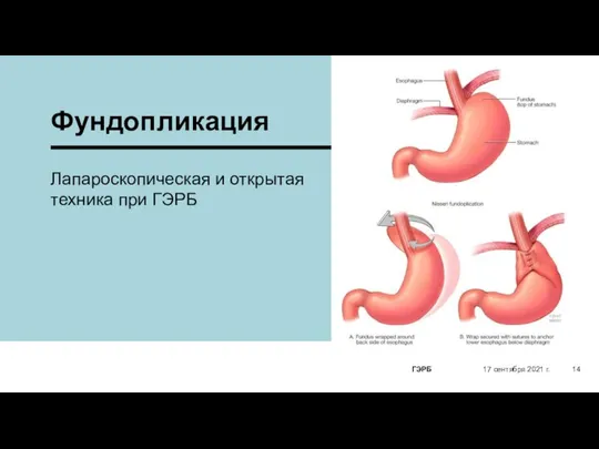 Фундопликация 17 сентября 2021 г. ГЭРБ Лапароскопическая и открытая техника при ГЭРБ