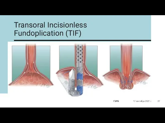 Transoral Incisionless Fundoplication (TIF) 17 сентября 2021 г. ГЭРБ