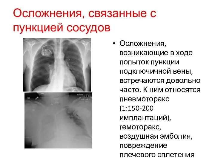 Осложнения, связанные с пункцией сосудов Осложнения, возникающие в ходе попыток пункции