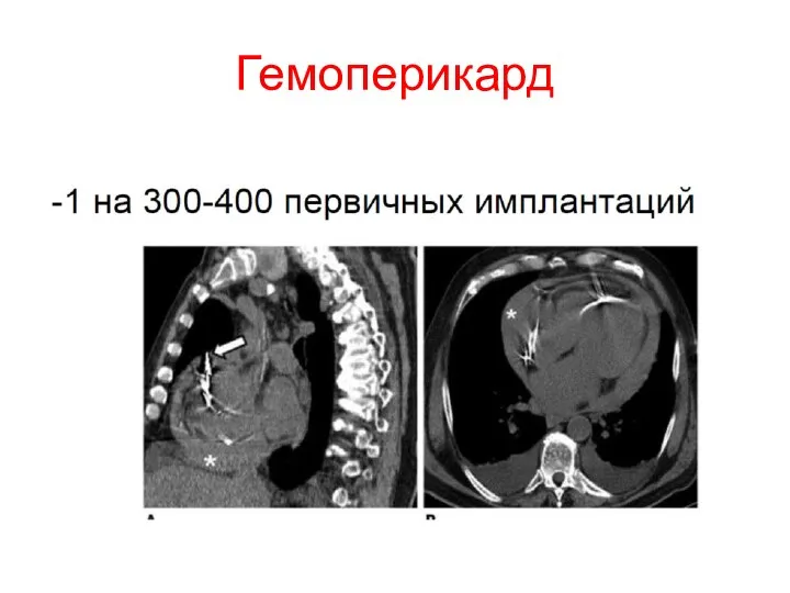 Гемоперикард