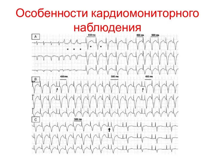 Особенности кардиомониторного наблюдения
