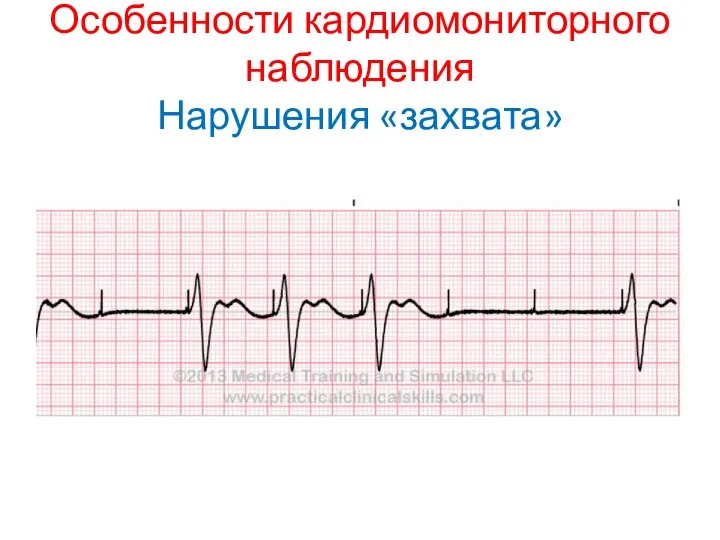 Особенности кардиомониторного наблюдения Нарушения «захвата»