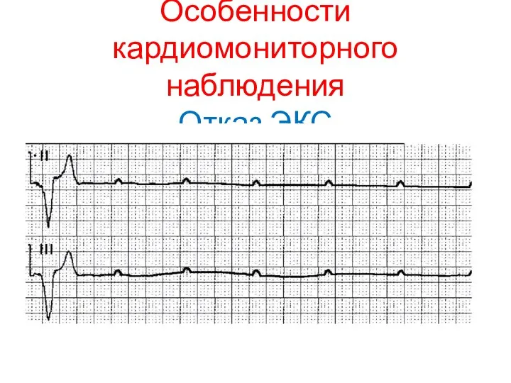 Особенности кардиомониторного наблюдения Отказ ЭКС