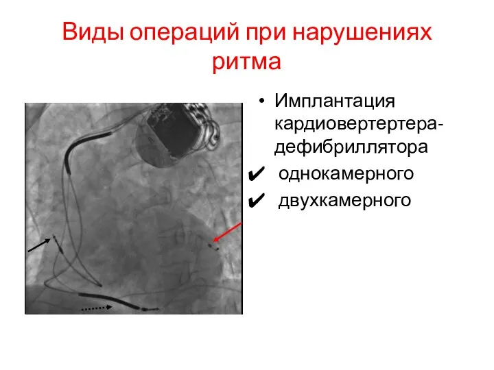 Виды операций при нарушениях ритма Имплантация кардиовертертера-дефибриллятора однокамерного двухкамерного