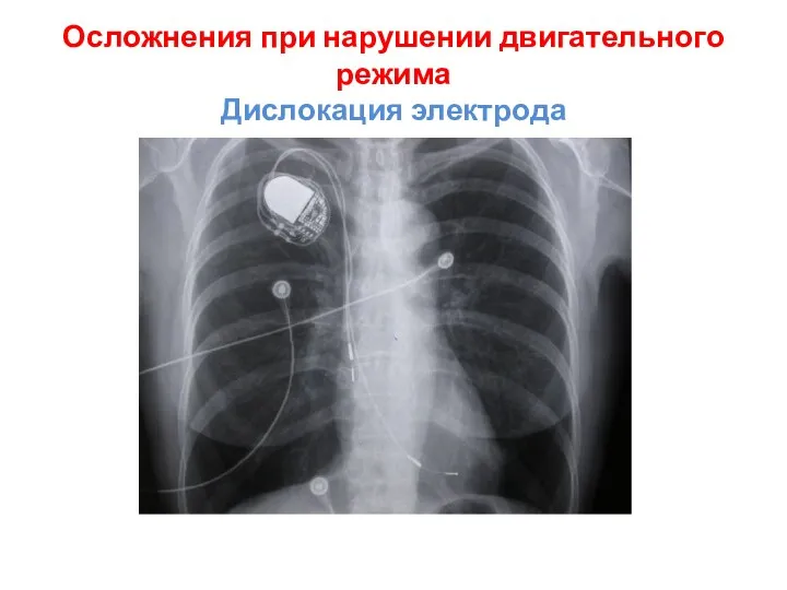 Осложнения при нарушении двигательного режима Дислокация электрода