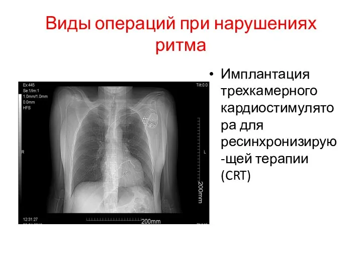 Виды операций при нарушениях ритма Имплантация трехкамерного кардиостимулятора для ресинхронизирую-щей терапии (CRT)