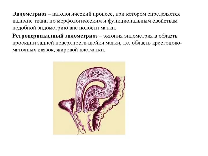 Эндометриоз – патологический процесс, при котором определяется наличие ткани по морфологическим