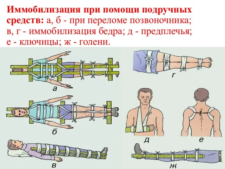 Иммобилизация при помощи подручных средств: а, б - при переломе позвоночника;