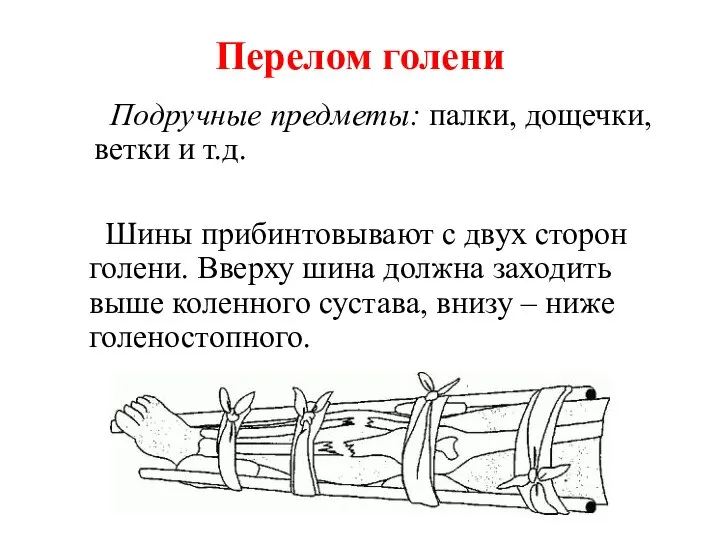 Перелом голени Подручные предметы: палки, дощечки, ветки и т.д. Шины прибинтовывают