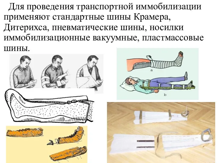 Для проведения транспортной иммобилизации применяют стандартные шины Крамера, Дитерихса, пневматические шины, носилки иммобилизационные вакуумные, пластмассовые шины.