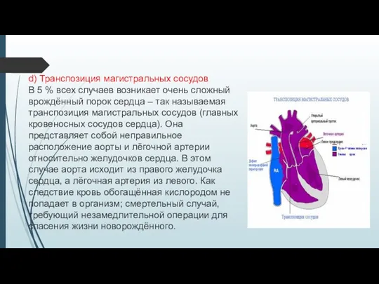 d) Транспозиция магистральных сосудов В 5 % всех случаев возникает очень