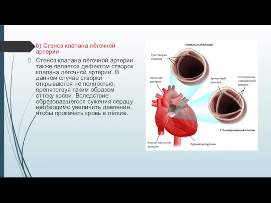 b) Стеноз клапана лёгочной артерии Стеноз клапана лёгочной артерии также является