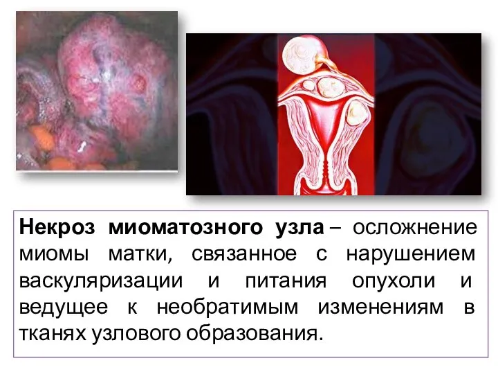 Некроз миоматозного узла – осложнение миомы матки, связанное с нарушением васкуляризации