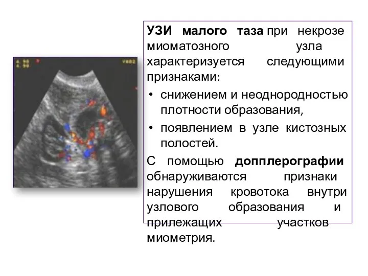 УЗИ малого таза при некрозе миоматозного узла характеризуется следующими признаками: снижением