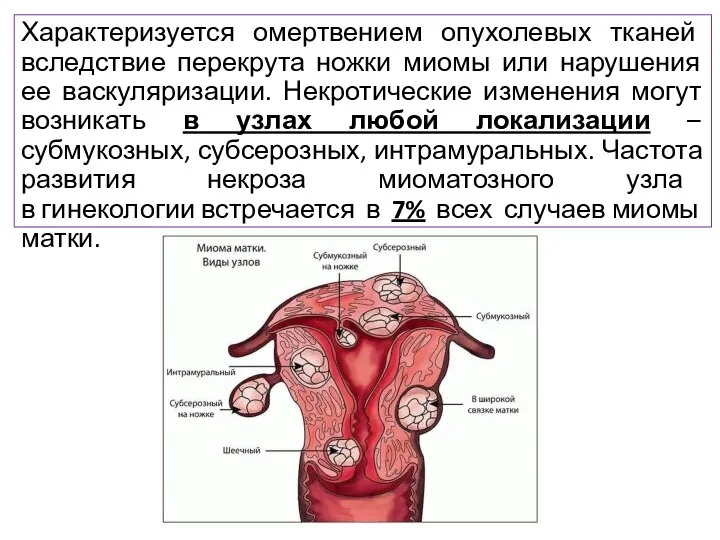 Характеризуется омертвением опухолевых тканей вследствие перекрута ножки миомы или нарушения ее