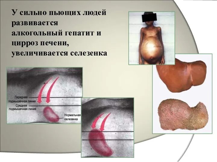 У сильно пьющих людей развивается алкогольный гепатит и цирроз печени, увеличивается селезенка