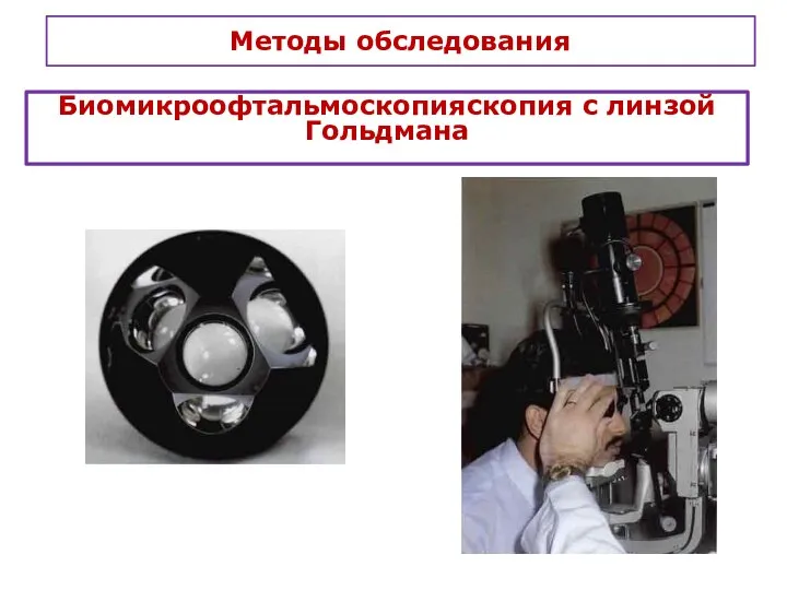 Методы обследования Биомикроофтальмоскопияскопия с линзой Гольдмана