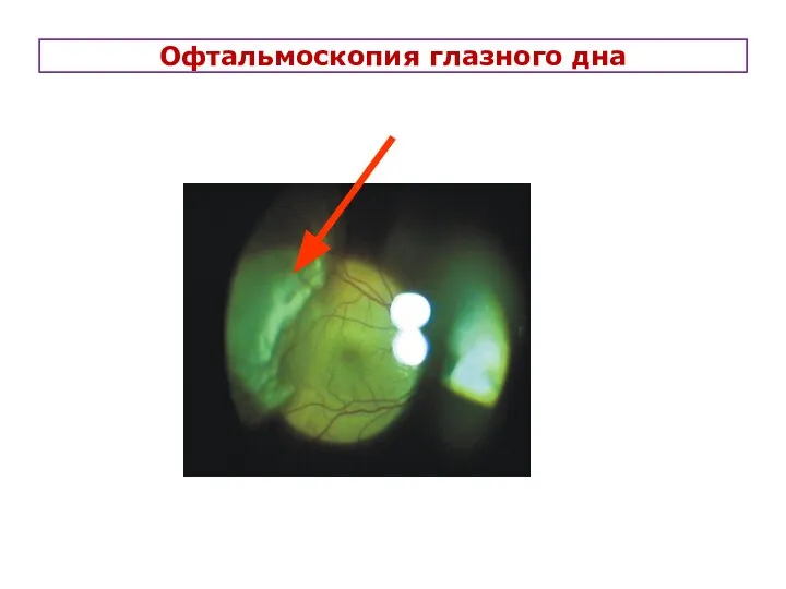 Офтальмоскопия глазного дна