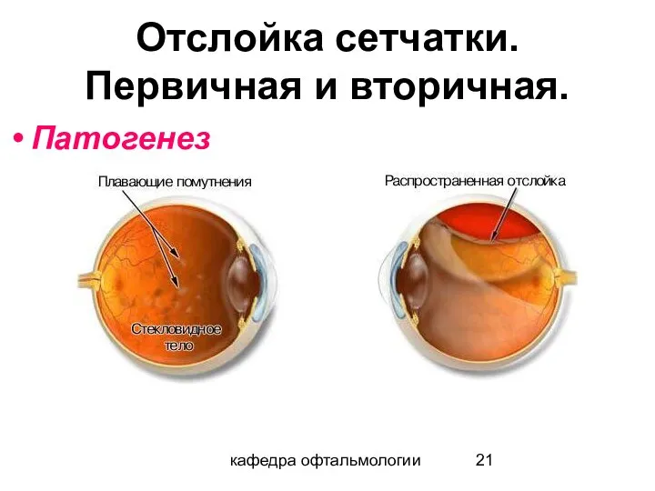 кафедра офтальмологии Отслойка сетчатки. Первичная и вторичная. Патогенез