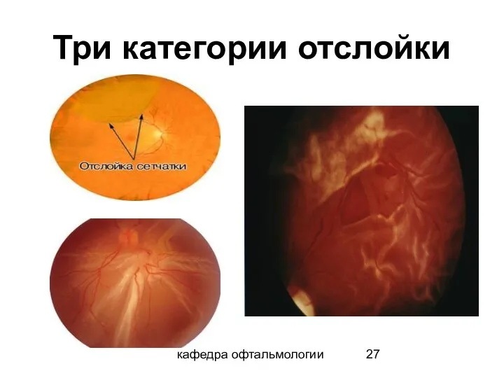 кафедра офтальмологии Три категории отслойки