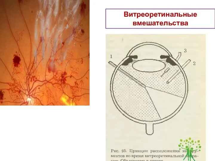 Витреоретинальные вмешательства