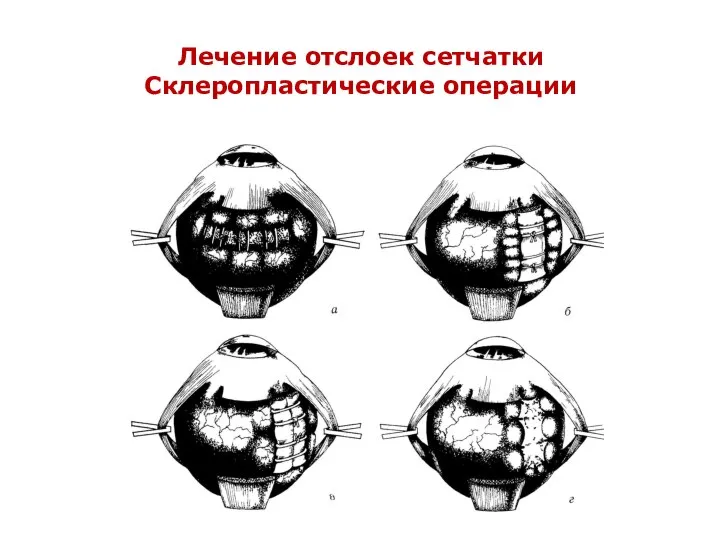 Лечение отслоек сетчатки Склеропластические операции