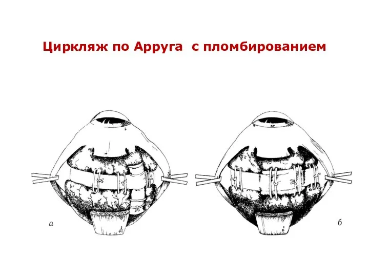 Циркляж по Арруга с пломбированием