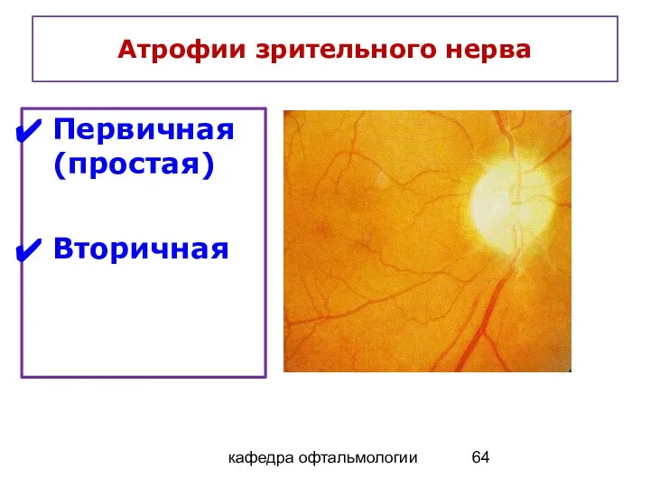 кафедра офтальмологии Атрофии зрительного нерва Первичная (простая) Вторичная