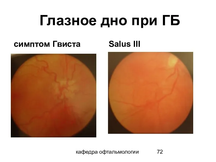 кафедра офтальмологии Глазное дно при ГБ симптом Гвиста Salus III